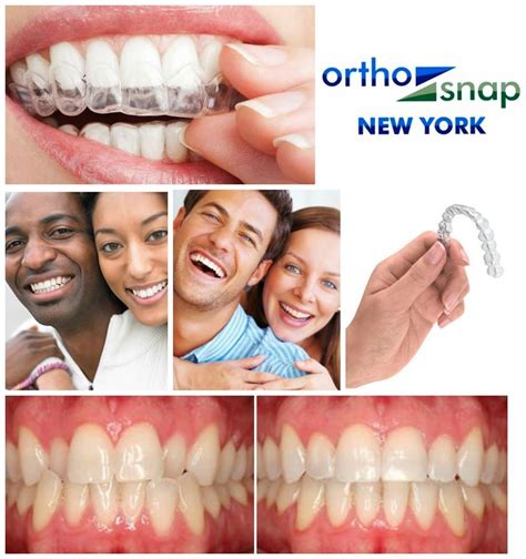 Orthosnap‬ Clear ‪‎aligners‬ Are Smooth And Comfortable Unlike Sharp