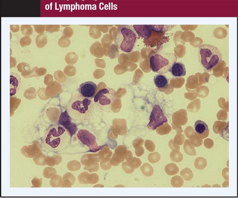 Figure 3 From Successful Autologous Peripheral Blood Stem Cell