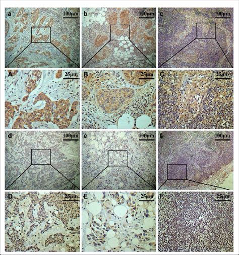 Representative Immunostaining For Laptm B Expression In Breast Cancer