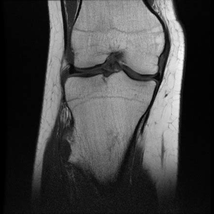 Osteochondroma Image Radiopaedia Org