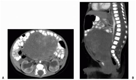 Cancer as related to Childhood Rhabdomyosarcoma - Pictures