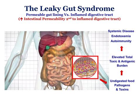 The leaky gut syndrome | PPTX