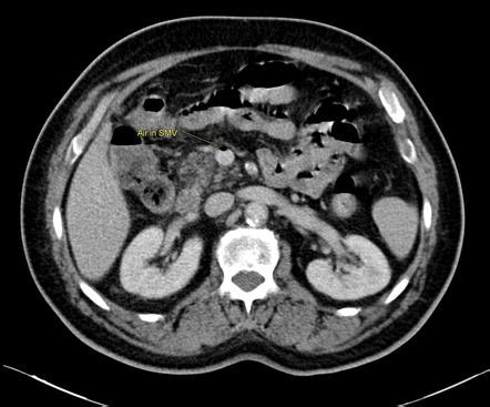 Ischemic Colitis Image Radiopaedia Org