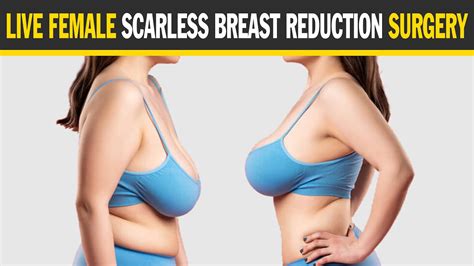 Live Female Scarless Breast Reduction Surgery YouTube