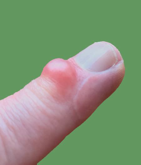 Mucous Cysts Aberdeen Virtual Hand Clinic