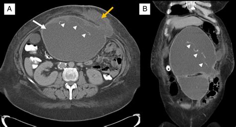 Delayed Onset Seroma Formation ‘opting Out At 5 Years After Ventral