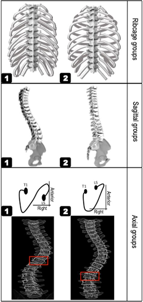 The Rib Cage Sagittal And Axial Subtypes Rib Cage Subtype Included