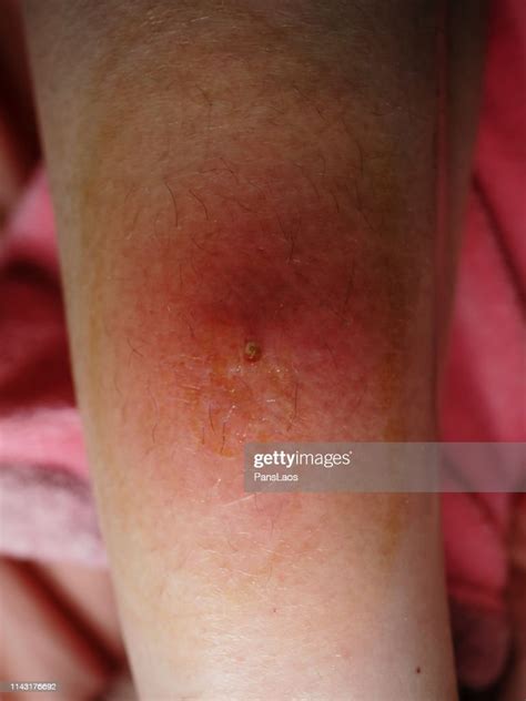 Skin Boil Furuncle Folliculitis On Leg High Res Stock Photo Getty Images