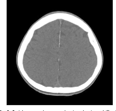 Figure 3 from Nevoid Basal Cell Carcinoma Syndrome: A Case Report and ...