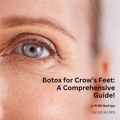 Botox For Crows Feet A Comprehensive Guide PURE Medical Spa