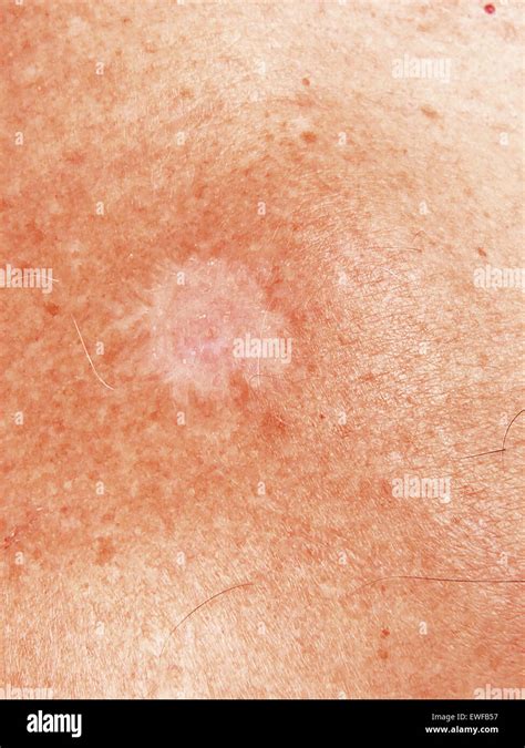 Basal Cell Carcinoma Stock Photo Alamy