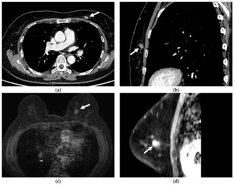 Missed And Detected Incidental Breast Cancers On Contrast Enhanced