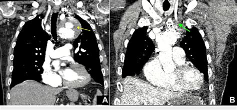 A Type Iii Endoleak In The Distal Aortic Arch Resulting In Increased