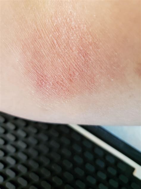 What Is It Dry Cracking Itchy Rash Inside Elbow For Approx 1 Month R Dermatologyquestions