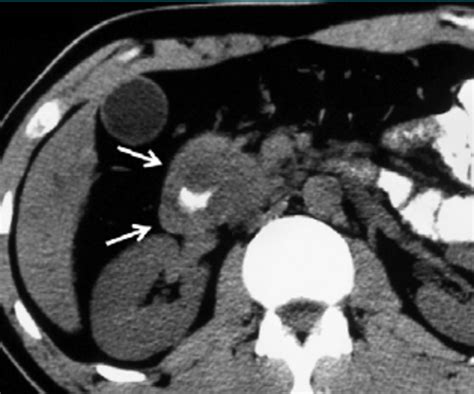 Ercp Spot Image Of Annular Pancreas In 43 Year Old Man Shows Mild Download Scientific Diagram