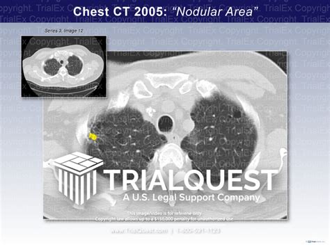 Chest Ct Nodular Area Trialquest Inc