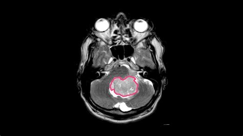 Anaplastic Ependymoma - StoryMD