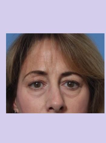 Blepharoplasty Archives Anthony Youn Md Facs