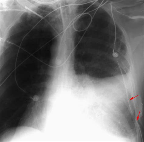 Icu Chest Films