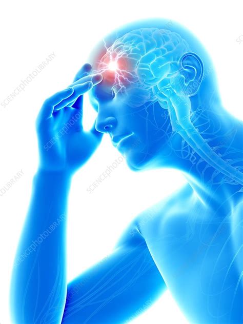 Human Headache Illustration Stock Image F Science Photo