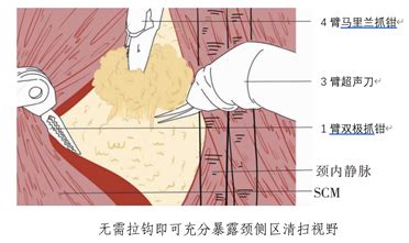 机器人甲状腺手术再添新突破颈侧方淋巴结清扫术 重庆大学附属三峡医院官网