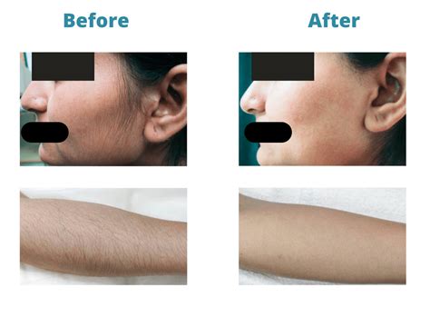 Laser Hair Removal Sama Hospital A Nabh Accredited Hospital In South Delhi