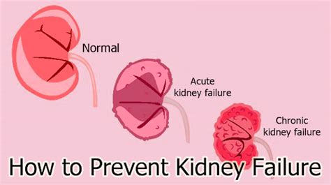 How To Prevent Kidney Failure