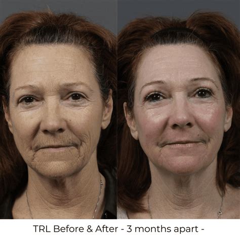 Trl Laser Resurfacing Mt Pleasant Sc Germain Dermatology