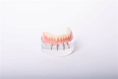 Do All-on-4® Implants Look Natural? - New Foundation Dental Implant ...