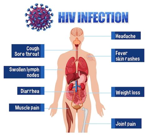 Cartaz Informativo Da Infecção Pelo Hiv Vetor Grátis