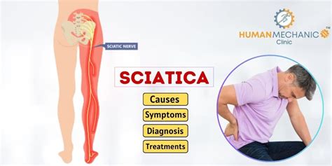 Sciatica Nerve Pain - Causes, Symptoms, Diagnosis & Treatments