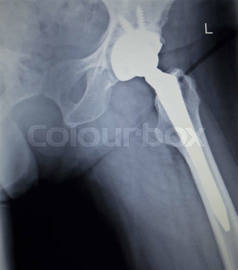 X Ray Scan Image Of Hip Joint Replacement Orthopedic Implant Stock