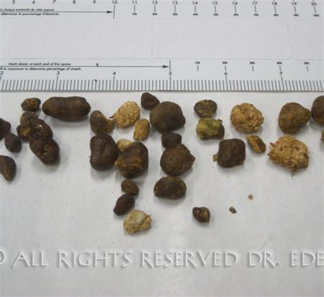 Gallstone Pictures Gallery See Images Of Real Gallstones Passed