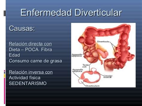 Enfermedad Diverticular 2017