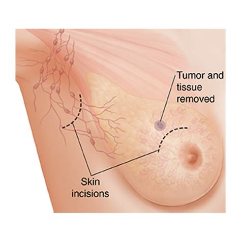 BREAST LUMPECTOMY Dr Gerhard Basson