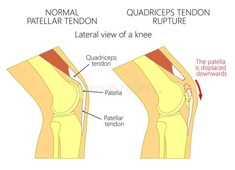 Knie Bursitis Superficial Infrapatellar Bursitis Vektor Abbildung