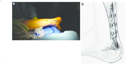 a. Achilles tendon after minimally invasive, endoscopic Achilles tendon... | Download Scientific ...