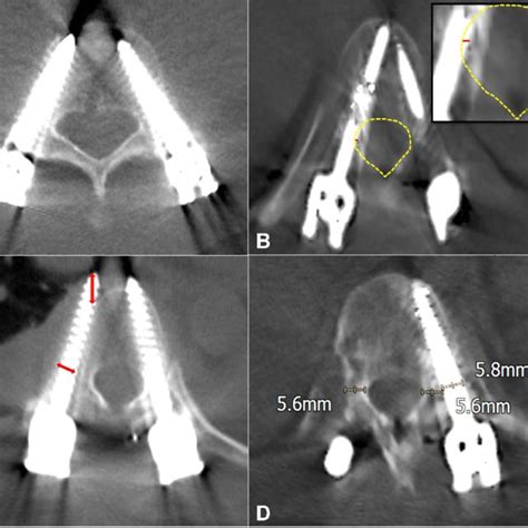 Ct Image Evaluation For Pedicle Screw Breach A Gertzbein Robbins Download Scientific Diagram