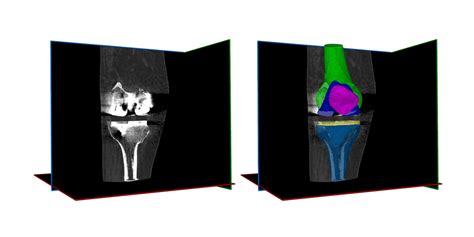 Rsip Vision Unveils Metal Implant And Joint Segmentation Tool Axis