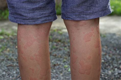 Hives And Heat Rash Diagnosis And Treatment