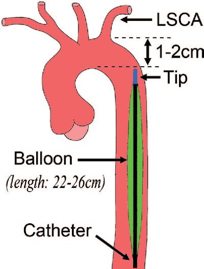 Pdf Positioning An Intraaortic Balloon Pump Using Intraoperative