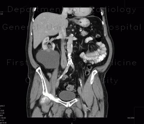 Radiology case: Complicated cyst, Bosniak III