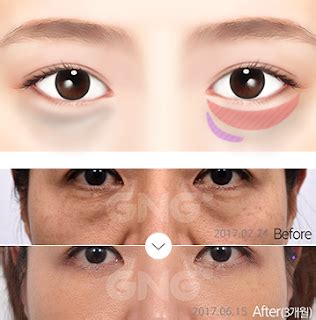 GNG Plastic Surgery Hospital: What is Under Eye Fat Correction?