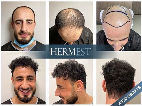 The Top 10 Best Hair Transplant In Turkey Hermest Clinic