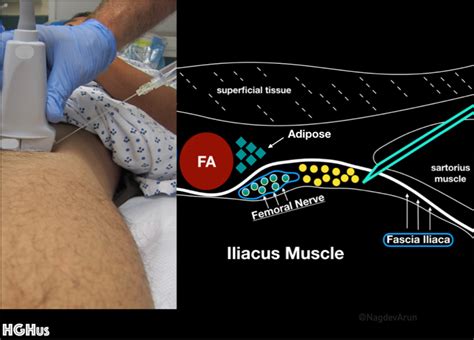 Femoral Nerve Block Distribution