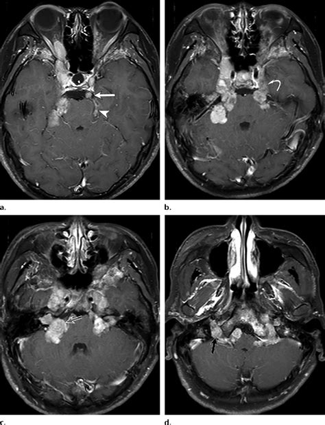 Multiple Schwannomas Involving Cranial Nerves In Neurofibromatosis Type