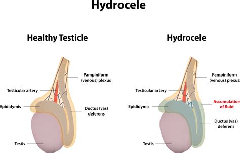 Testículos inflamados Conoce más sobre la hidrocele Estilo de Vida