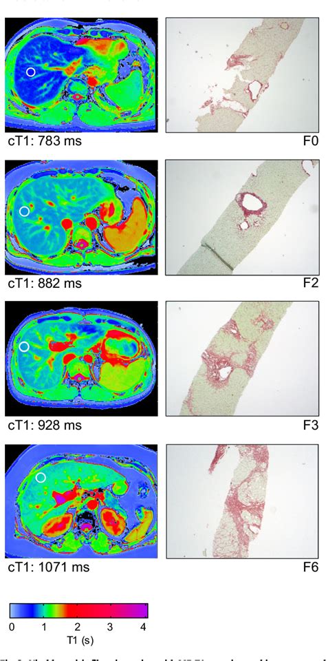 PDF Multiparametric Magnetic Resonance For The Non Invasive Diagnosis