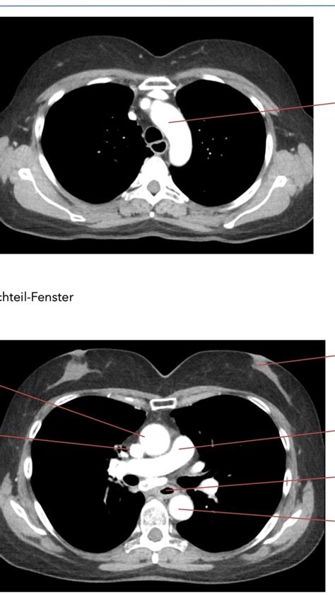 Schaubild Schnittbildanatomie Thorax 2 Quizlet