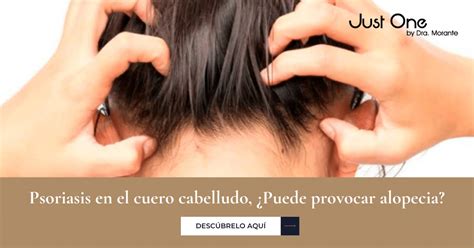 Psoriasis En El Cuero Cabelludo ¿puede Provocar Alopecia